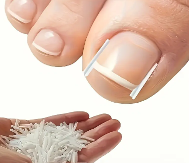 Kit para uñas encarnadas